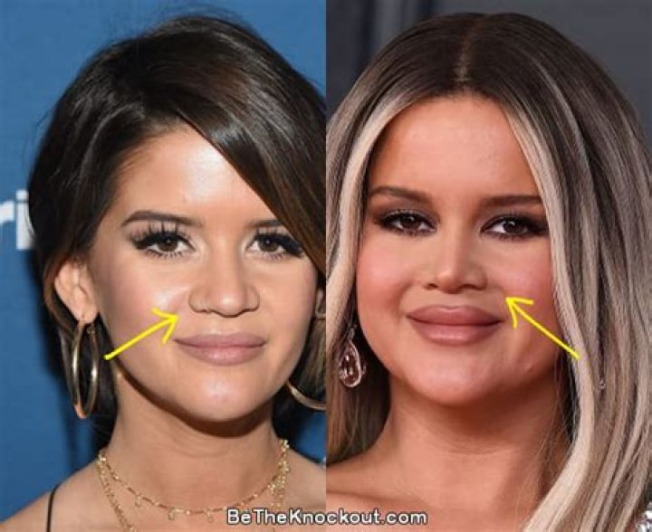Did Maren Morris Get Botox? Here Is What The Singer Looks Before & After Plastic Surgery