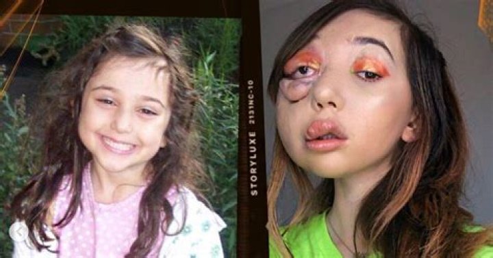 What Happened To Nikki Lilly Eye? British YouTuber Before Diseases Photos- Surgery And Life Expectancy